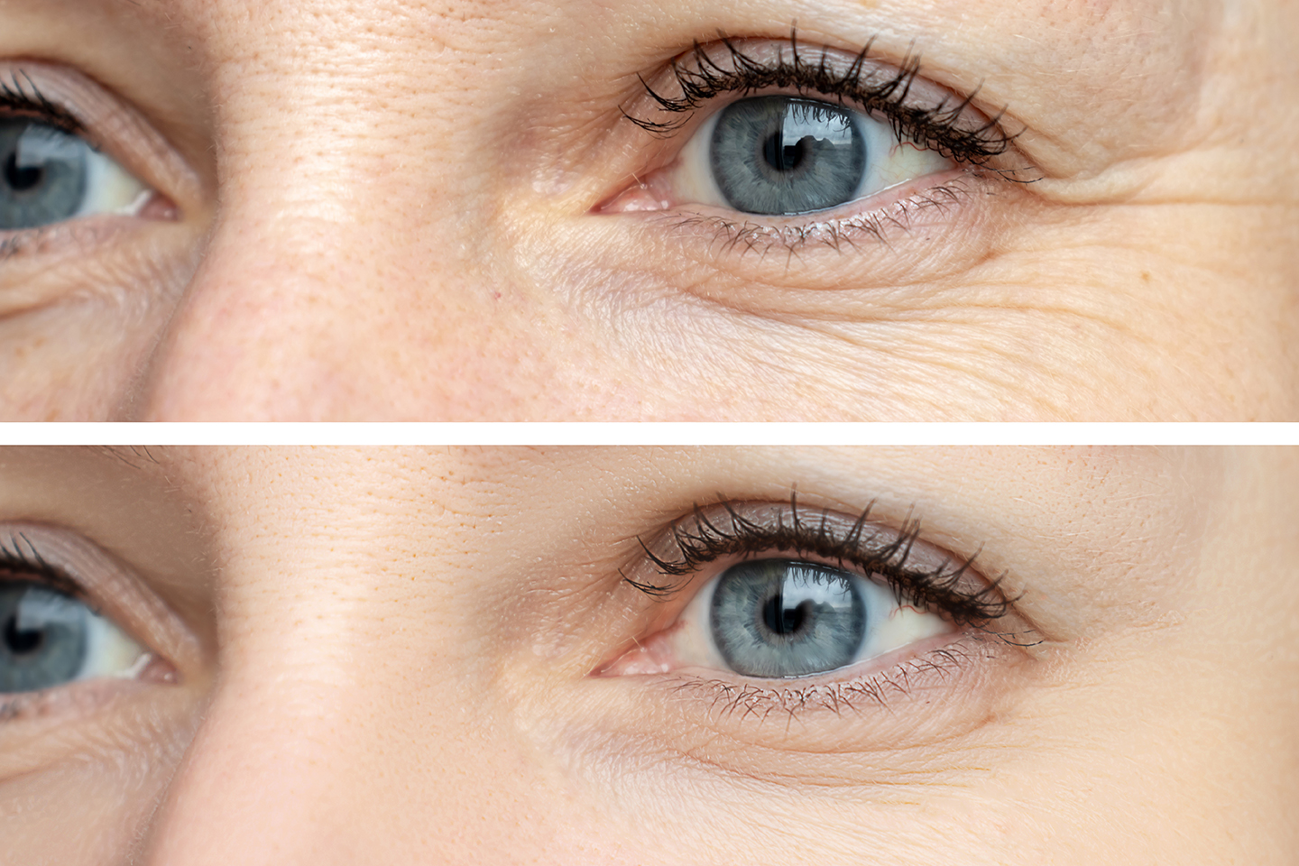 Can BOTOX® at an Early Age Help Prevent Future Wrinkles?