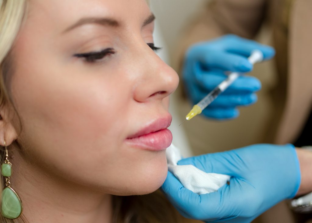 Woman receiving lip filler treatment with a syringe in a cosmetic procedure, highlighting the application of dermal fillers for facial enhancement.