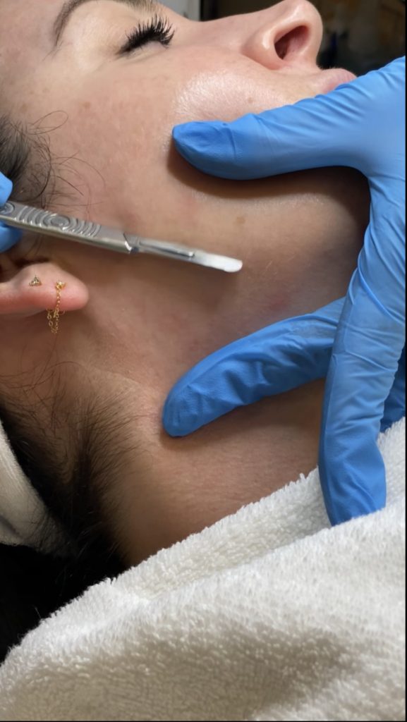 Woman undergoing dermaplaning treatment with a gloved hand holding a surgical tool, emphasizing skincare and anti-aging benefits at Luxe Aesthetic Center.
