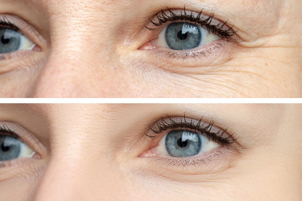 Close-up comparison of aging skin around the eyes, showing visible wrinkles and fine lines above, and smoother, rejuvenated skin below, highlighting the effects of aesthetic treatments like Botox and skincare products.