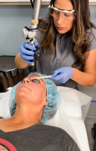Microneedling California