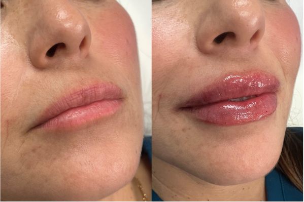 Lip Augmentation