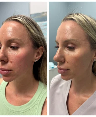 Patient treated with 1 vial of Sculptra & 1 syringe Restylane Contour.