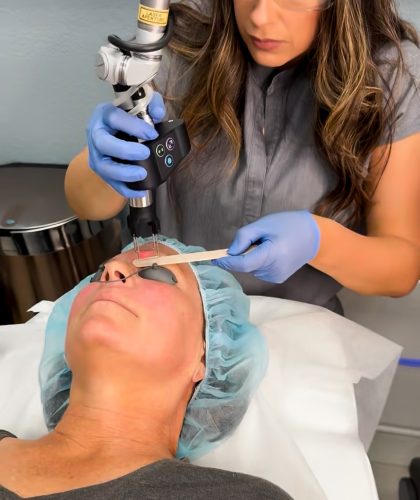 Microneedling California
