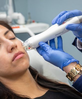 RF microneedling