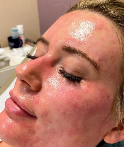 Chemical Peel