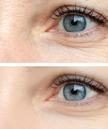 Woman face, eye wrinkles before and after treatment - the result of rejuvenating cosmetological procedures of biorevitalization, botox and pigment spots removal.